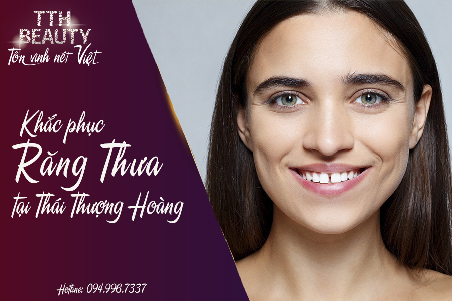 KHẮC PHỤC RĂNG THƯA TẠI THÁI THƯỢNG HOÀNG